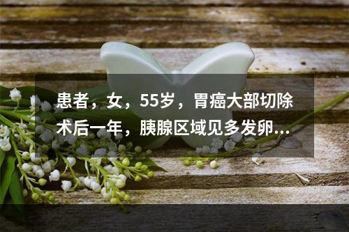 患者，女，55岁，胃癌大部切除术后一年，胰腺区域见多发卵圆形