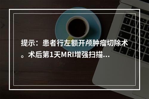 提示：患者行左额开颅肿瘤切除术。术后第1天MRI增强扫描，提