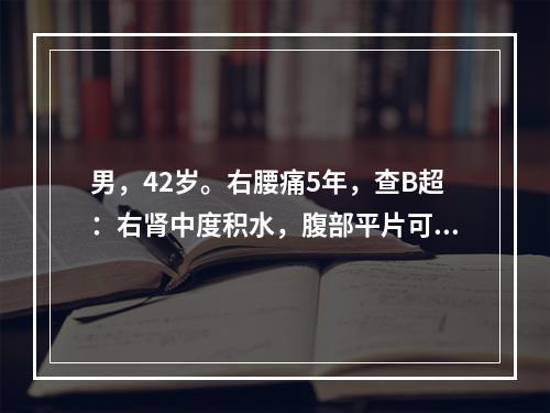 男，42岁。右腰痛5年，查B超：右肾中度积水，腹部平片可见右