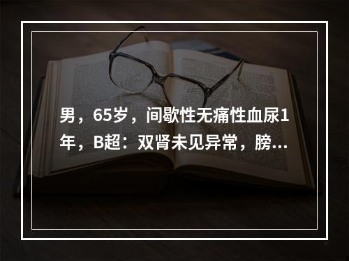 男，65岁，间歇性无痛性血尿1年，B超：双肾未见异常，膀胱右