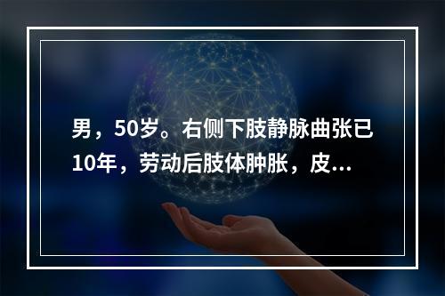 男，50岁。右侧下肢静脉曲张已10年，劳动后肢体肿胀，皮炎及