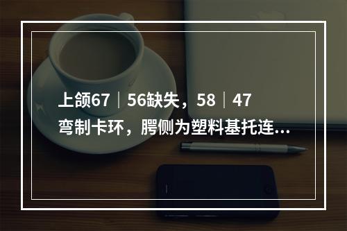 上颌67｜56缺失，58｜47弯制卡环，腭侧为塑料基托连接