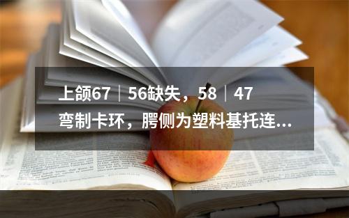 上颌67｜56缺失，58｜47弯制卡环，腭侧为塑料基托连接