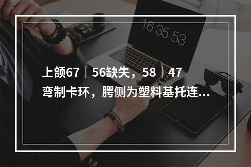 上颌67｜56缺失，58｜47弯制卡环，腭侧为塑料基托连接