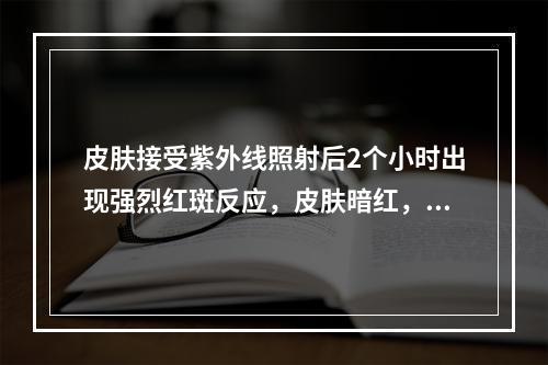 皮肤接受紫外线照射后2个小时出现强烈红斑反应，皮肤暗红，水肿