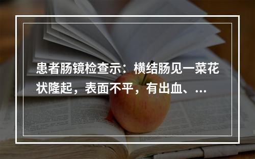 患者肠镜检查示：横结肠见一菜花状隆起，表面不平，有出血、糜烂