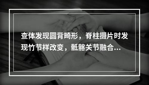 查体发现圆背畸形，脊柱摄片时发现竹节样改变，骶髂关节融合，应