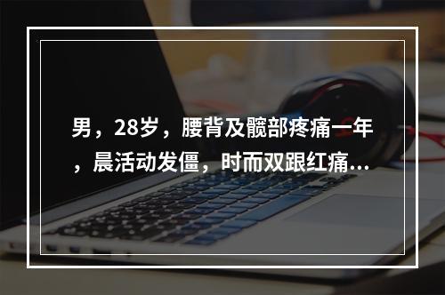 男，28岁，腰背及髋部疼痛一年，晨活动发僵，时而双跟红痛。查