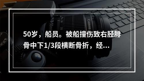 50岁，船员。被船撞伤致右胫腓骨中下1/3段横断骨折，经复位