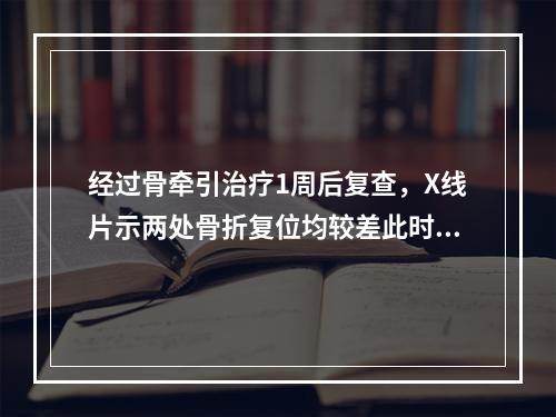 经过骨牵引治疗1周后复查，X线片示两处骨折复位均较差此时最好