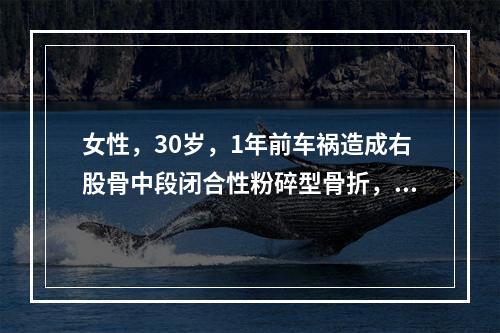 女性，30岁，1年前车祸造成右股骨中段闭合性粉碎型骨折，曾行