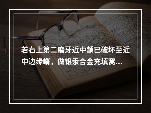 若右上第二磨牙近中龋已破坏至近中边缘嵴，做银汞合金充填窝洞制