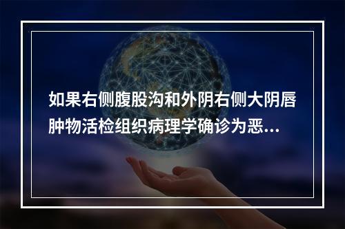 如果右侧腹股沟和外阴右侧大阴唇肿物活检组织病理学确诊为恶性肿