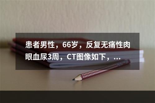 患者男性，66岁，反复无痛性肉眼血尿3周，CT图像如下，最有