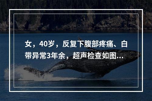 女，40岁，反复下腹部疼痛、白带异常3年余，超声检查如图，最