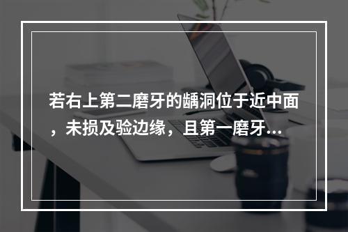 若右上第二磨牙的龋洞位于近中面，未损及验边缘，且第一磨牙缺失