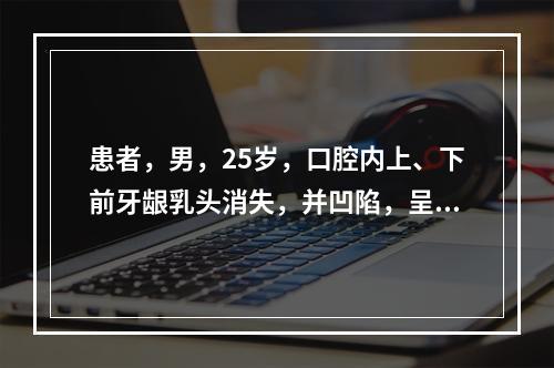 患者，男，25岁，口腔内上、下前牙龈乳头消失，并凹陷，呈反波