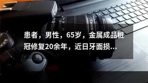 患者，男性，65岁，金属成品桩冠修复20余年，近日牙面损坏，