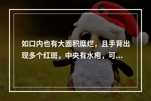 如口内也有大面积糜烂，且手背出现多个红斑，中央有水疱，可能是