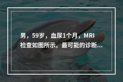 男，59岁，血尿1个月，MRI检查如图所示。最可能的诊断是