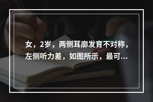 女，2岁，两侧耳廓发育不对称，左侧听力差，如图所示，最可能的