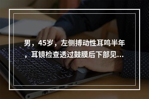 男，45岁，左侧搏动性耳鸣半年，耳镜检查透过鼓膜后下部见半膨