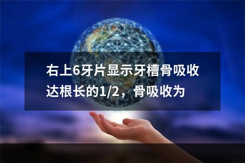 右上6牙片显示牙槽骨吸收达根长的1/2，骨吸收为