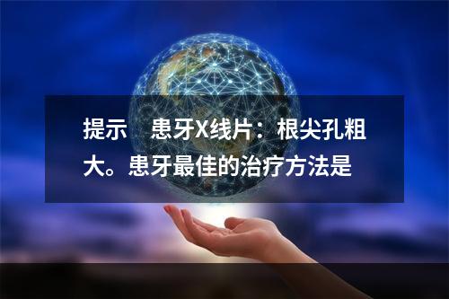 提示　患牙X线片：根尖孔粗大。患牙最佳的治疗方法是