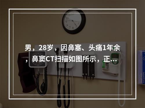 男，28岁，因鼻塞、头痛1年余，鼻窦CT扫描如图所示，正确的