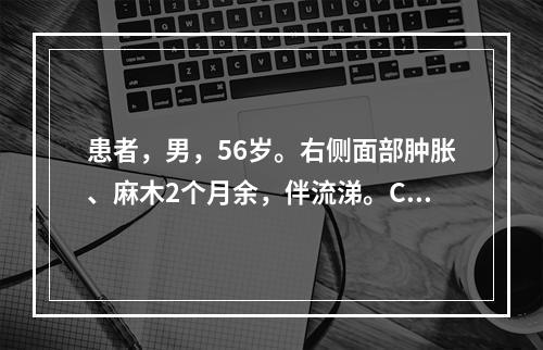 患者，男，56岁。右侧面部肿胀、麻木2个月余，伴流涕。CT示