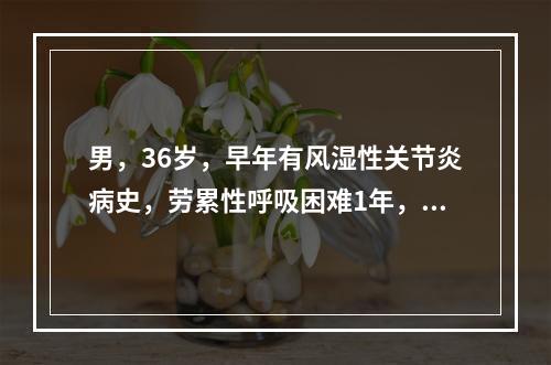 男，36岁，早年有风湿性关节炎病史，劳累性呼吸困难1年，近两