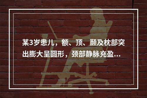 某3岁患儿，额、顶、颞及枕部突出膨大呈圆形，颈部静脉充盈，对