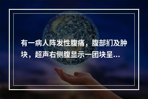 有一病人阵发性腹痛，腹部扪及肿块，超声右侧腹显示一团块呈“假