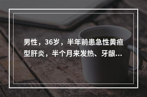 男性，36岁，半年前患急性黄疸型肝炎，半个月来发热、牙龈出血