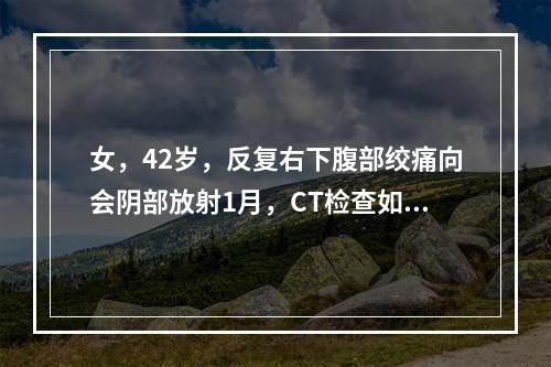 女，42岁，反复右下腹部绞痛向会阴部放射1月，CT检查如图示