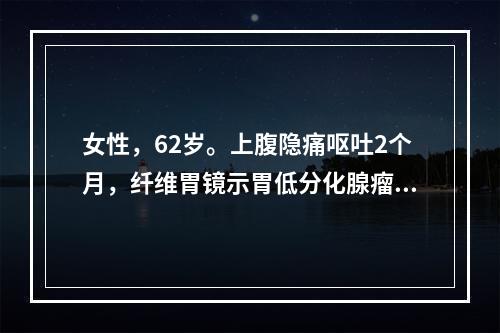 女性，62岁。上腹隐痛呕吐2个月，纤维胃镜示胃低分化腺瘤，术