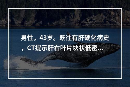 男性，43岁。既往有肝硬化病史，CT提示肝右叶片块状低密度影