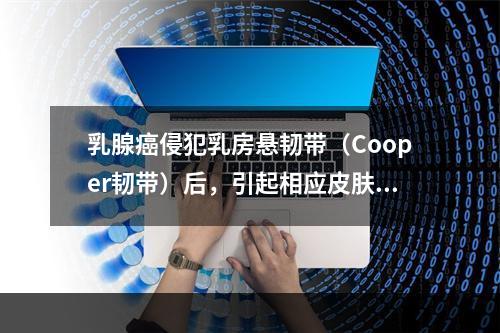 乳腺癌侵犯乳房悬韧带（Cooper韧带）后，引起相应皮肤改变