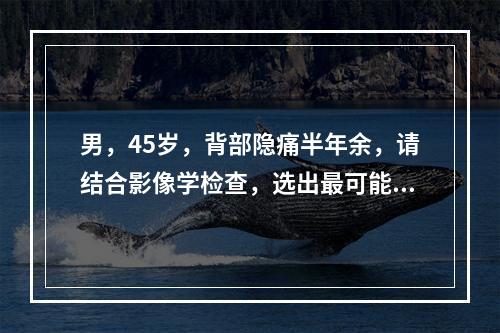 男，45岁，背部隐痛半年余，请结合影像学检查，选出最可能的诊