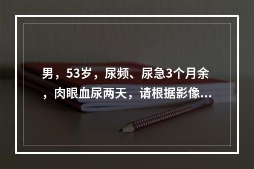 男，53岁，尿频、尿急3个月余，肉眼血尿两天，请根据影像，判