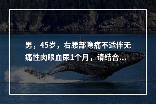 男，45岁，右腰部隐痛不适伴无痛性肉眼血尿1个月，请结合图像