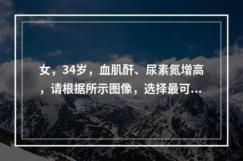 女，34岁，血肌酐、尿素氮增高，请根据所示图像，选择最可能诊