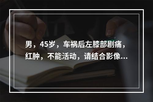 男，45岁，车祸后左膝部剧痛，红肿，不能活动，请结合影像学检