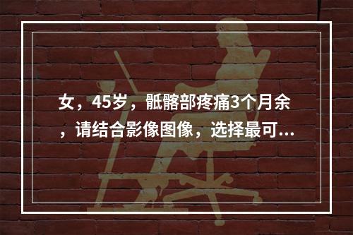 女，45岁，骶髂部疼痛3个月余，请结合影像图像，选择最可能的