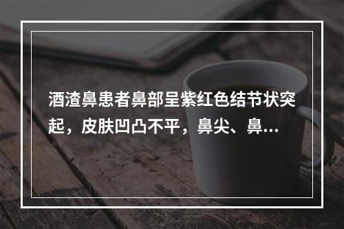 酒渣鼻患者鼻部呈紫红色结节状突起，皮肤凹凸不平，鼻尖、鼻翼肥