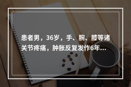 患者男，36岁，手、腕、膝等诸关节疼痛，肿胀反复发作6年，指