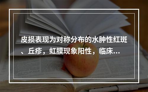 皮损表现为对称分布的水肿性红斑、丘疹，虹膜现象阳性，临床考虑