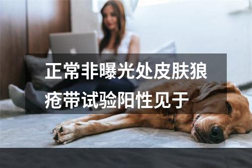 正常非曝光处皮肤狼疮带试验阳性见于