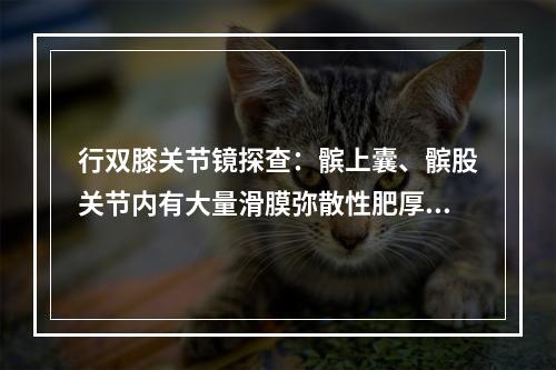 行双膝关节镜探查：髌上囊、髌股关节内有大量滑膜弥散性肥厚，成