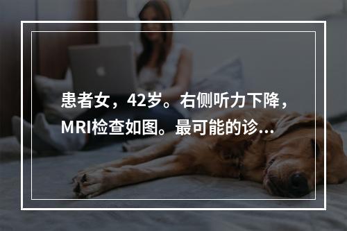 患者女，42岁。右侧听力下降，MRI检查如图。最可能的诊断为